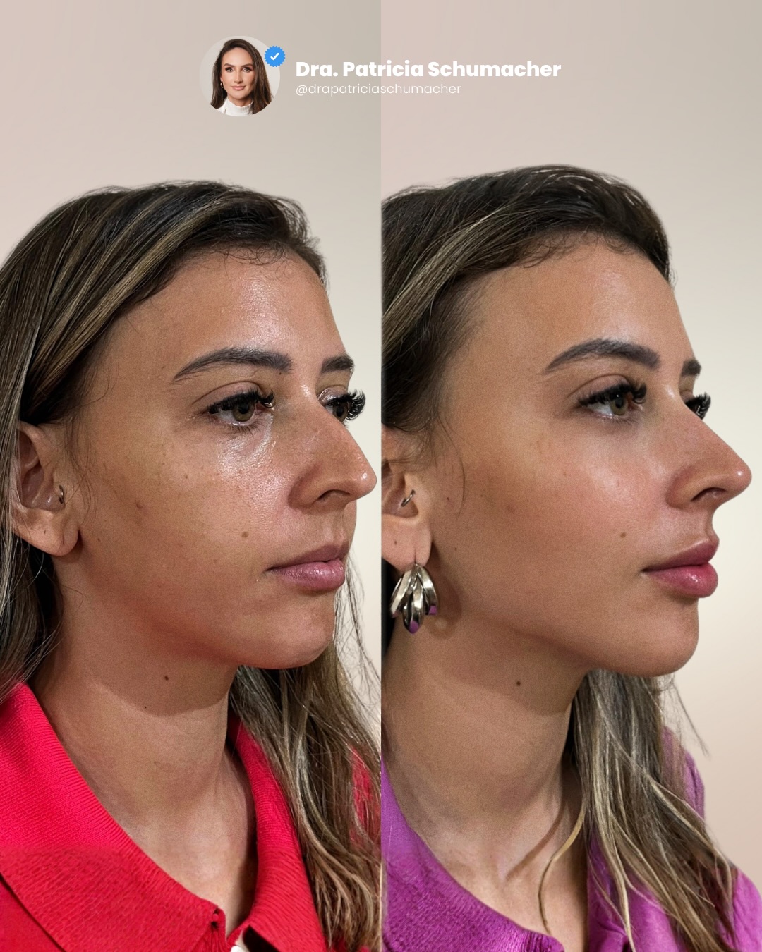 Antes e Depois Harmonização Facial Dra. Patrícia Schumacher