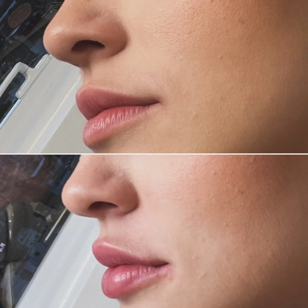 Antes (acima) e depois (abaixo) de preenchimento labial, vista de perfil