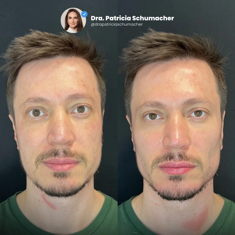 Antes e depois de harmonização facial masculina, vista frontal