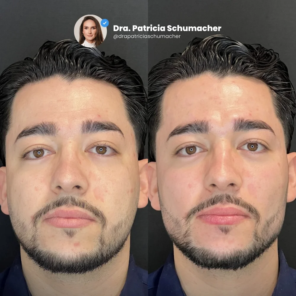 Antes e depois de harmonização facial masculina, vista frontal