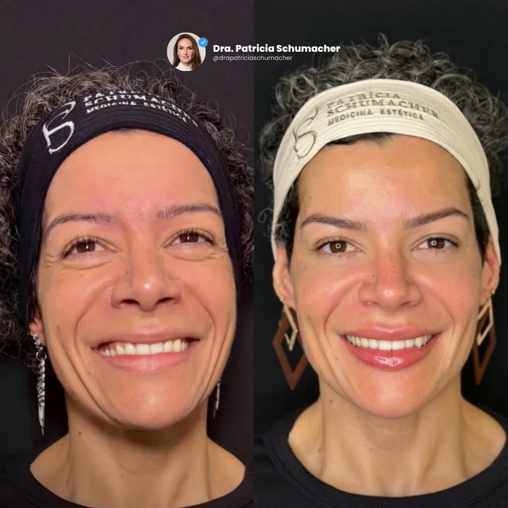 Antes e depois do primeiro procedimento estético, vista frontal